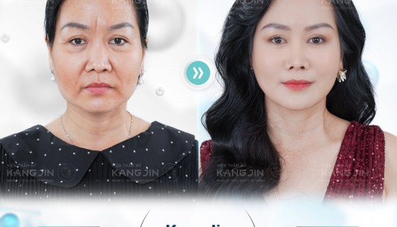 Nâng cơ mặt chảy xệ bằng liệu pháp trẻ hóa da KangJin Max Collagen siêu vi điểm 