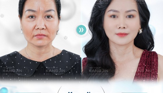 Liệu pháp KangJin Max Collagen siêu vi điểm cải thiện làn da bị lão hóa và thương tổn 