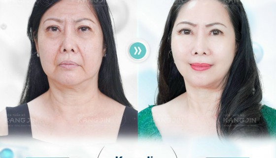 Công nghệ KangJin Max Collagen siêu vi điểm cải thiện làn da bị lão hóa và xóa nếp nhăn trên mặt rất hiệu quả
