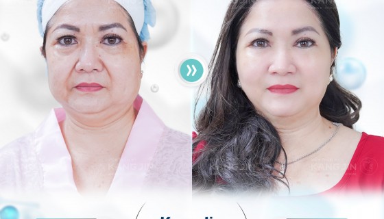 Nâng cơ mặt chảy xệ bằng liệu pháp cao sẽ giúp bạn đạt hiệu quả nhanh chóng hơn mà không tốn nhiều thời gian 