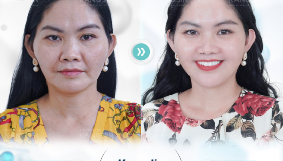 Liệu pháp KangJin Max Collagen Siêu Vi Điểm