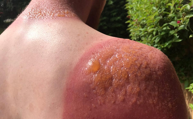 Làn da bị cháy nắng thường xuyên có thể ảnh hưởng tới sức khỏe làn da và gây mất thẩm mỹ