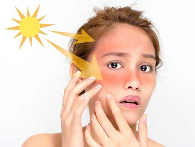 Nguyên nhân khiến làn da bị cháy nắng do tia UV trực tiếp mặt trời tác động vào làn da 