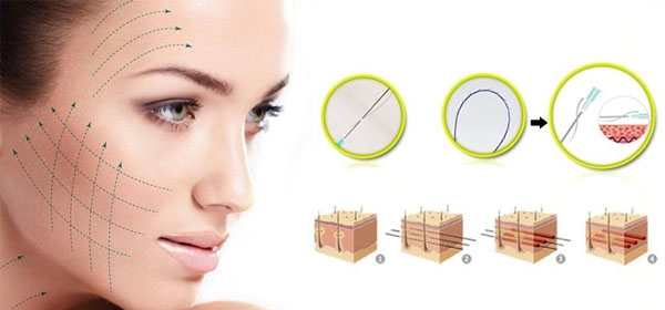 căng chỉ collagen