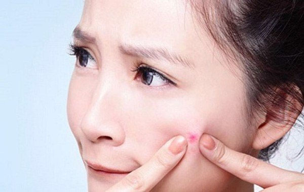 Nặn mụn