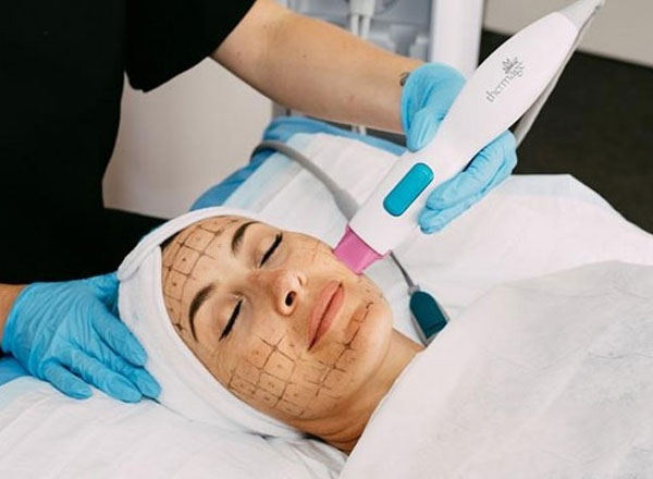 liệu pháp thermage FLX