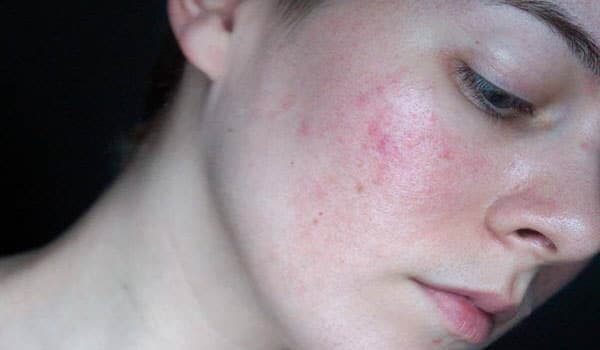 da mặt kích ứng là gì