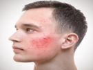 Nấm da mặt có nguy hiểm không? 7 Cách điều trị tại nhà