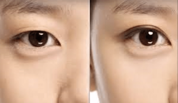 5 Cách khắc phục sụp mí mắt 1 bên bẩm sinh ở Nữ và Nam