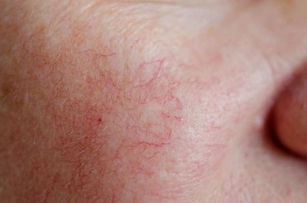 Dấu hiệu nhận biết da mặt mỏng nổi mạch máu bẩm sinh