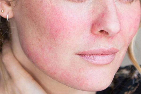 Da mặt dị ứng mẩn đỏ là bệnh gì