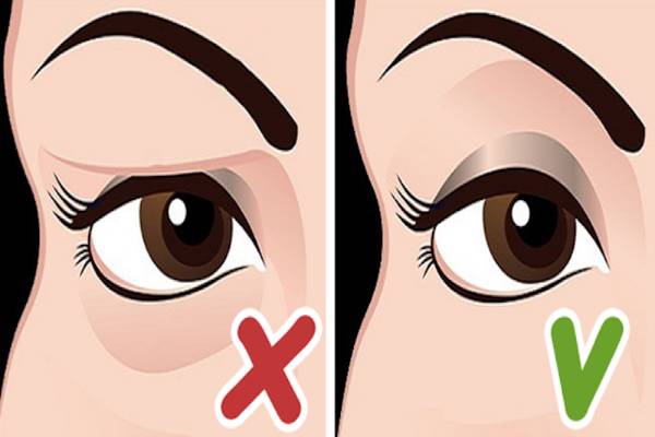 Dấu hiệu nhược cơ mí mắt có thể xuất hiện ở bất kỳ ai