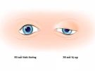 Bệnh sụp mí mắt nhược cơ có nguy hiểm không?