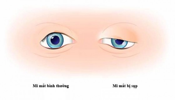 Sụp mí mắt nhược cơ có thể là coi là dấu hiệu ban đầu của bệnh nhược cơ. Điều này không chỉ ảnh hưởng đến thị giác mà còn gây mất thẩm mỹ cho khuôn mặt.