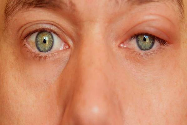 Đôi mắt không còn cân đối khi bị sụp mí mắt nhược cơ