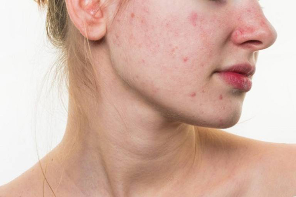 Da mặt sau khi tái tạo da bằng thuốc bắc rất cần chăm sóc da.