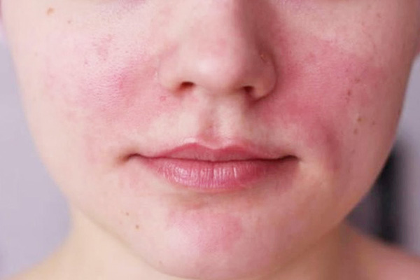Da mặt dễ mẩn đỏ khi mang thai