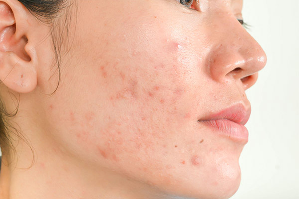 Da mặt có hiện tượng lên mụn sau khi tái tạo da thuốc bắc