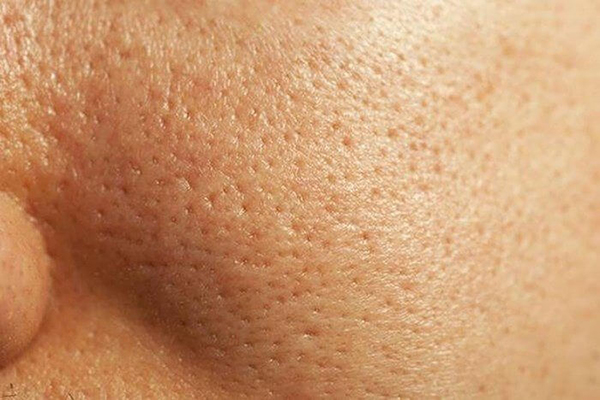 Tình trạng lỗ chân lông to sau khi lột mụn không được chăm sóc đúng cách