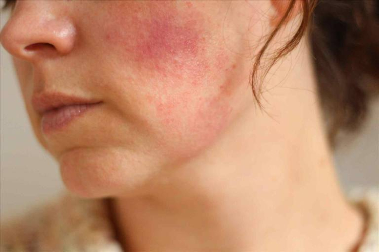 da mặt bị nhiễm corticoid ở mức độ nhẹ khiến da mẩn đỏ