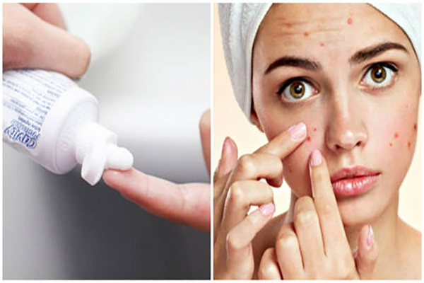 Kem đánh răng trị mụn sưng cứng