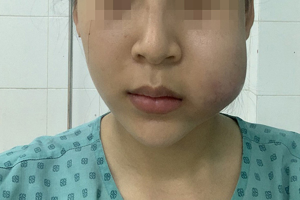 Biến chứng khi tiêm filler kém chất lượng