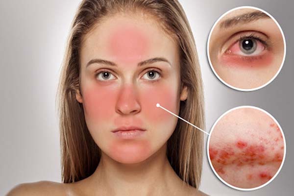 Một số dấu hiệu bạn cần biết để nhận biết da mặt dị ứng với mỹ phẩm