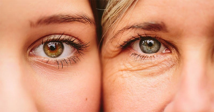 Phụ nữ bước vào độ tuổi lão hóa nên nâng cơ mắt