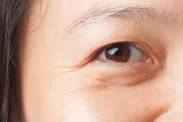 Nguyên nhân vùng da dưới mắt bị chảy xệ