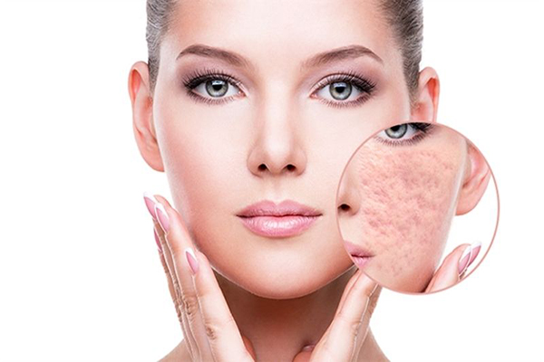 Dùng kem trị sẹo rỗ để phục hồi da