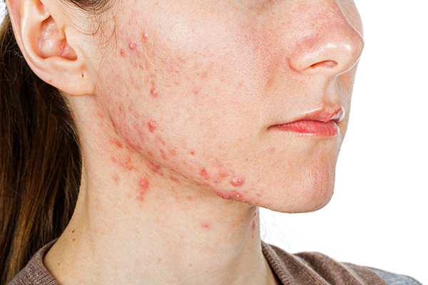 Bạn cần lưu ý chăm sóc da khi có dấu hiệu viêm da dị ứng