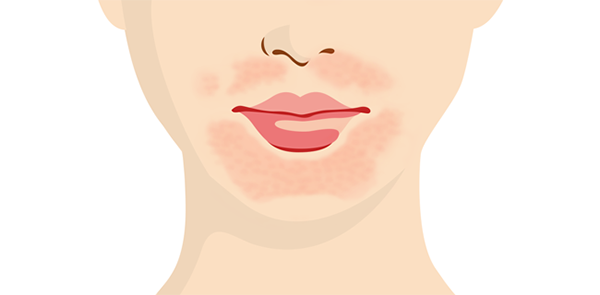 Vùng da quanh miệng không đều màu có thể do nhiều nguyên nhân 