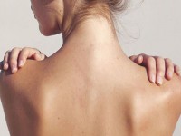 Vùng da lưng bị sạm đen rất khó điều trị