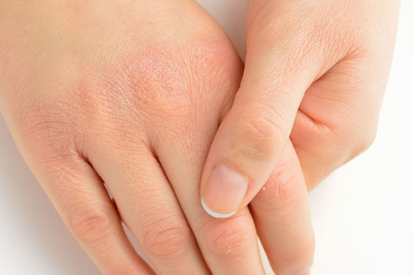 Nếp nhăn xuất hiện nhiều ở phần ngón tay