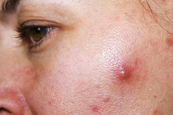 hoa đậu biếc trị mụn bọc, sưng viêm