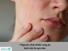 7 Nguyên nhân khiến vùng da dưới cằm bị sạm đen khó khắc phục