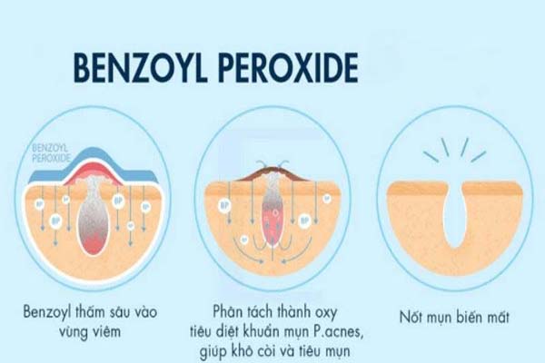 Cơ chế tác động của Benzoyl peroxide