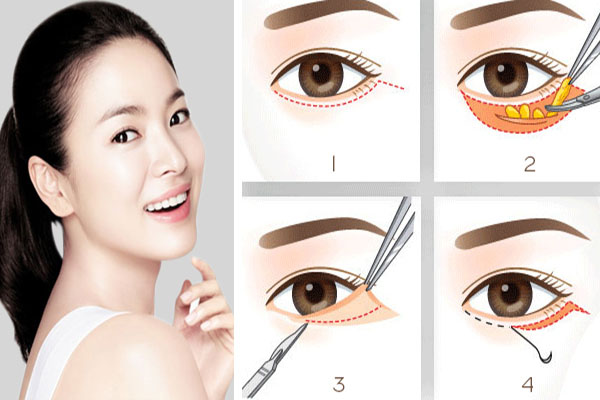 Lấy mỡ bọng mắt quá sâu sẽ ảnh hưởng đến vùng da quanh mắt