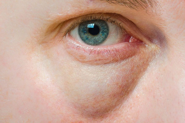 Bọng mắt dưới có thể xuất hiện do nhiều nguyên nhân nhưng đều mang đến cảm giác kém thẩm mỹ cho khuôn mặt