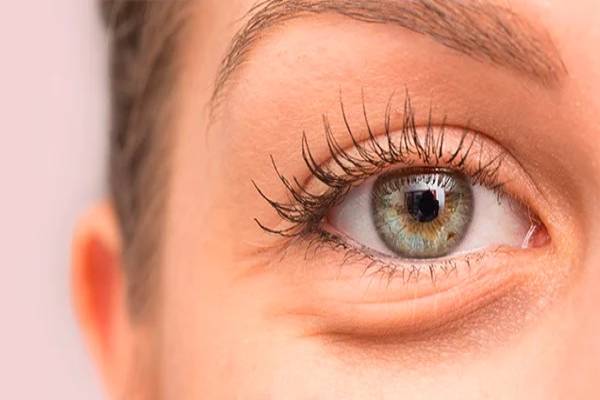 Bọng mỡ vùng da dưới mắt gây mất thẩm mỹ ảnh hưởng đến toàn bộ khuôn mặt