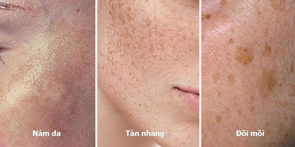 Các loại nám xuất hiện phổ biến trên da