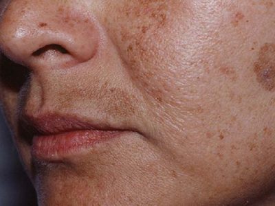 7 Cách trị nám vùng miệng và nguyên nhân khiến da sạm đen