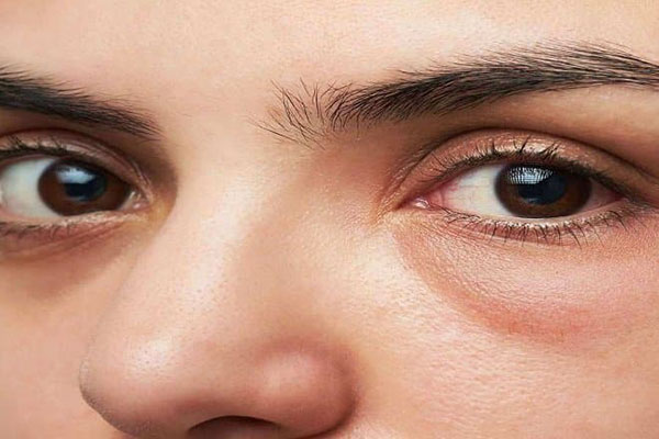 Có nên lấy mỡ bọng mắt không là câu hỏi nhiều người thắc mắc khi muốn điều trị tình trạng bọng mắt dưới da
