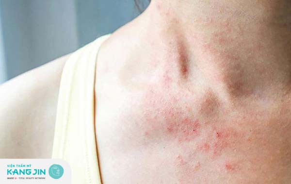 Da mẩn ngứa và ửng đỏ khi bị bệnh mề đay
