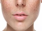 7 Cách trị đốm nâu trên da mặt thịnh hành hiện nay