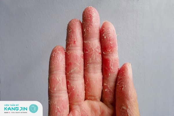 Dấu hiệu da tay bong tróc nhiều lớp cho thấy cơ thể đang thiếu nước