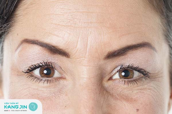 Da mặt xuất hiện nhiều nếp nhăn chảy xệ do quá trình lão hóa da nhanh chóng ở phụ nữ