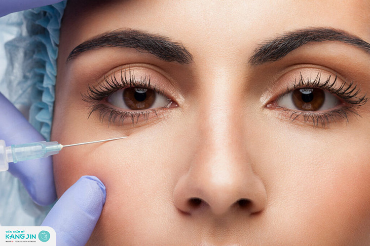 Các chuyên gia khuyên không nên tiêm filler để trẻ hóa da vùng mắt