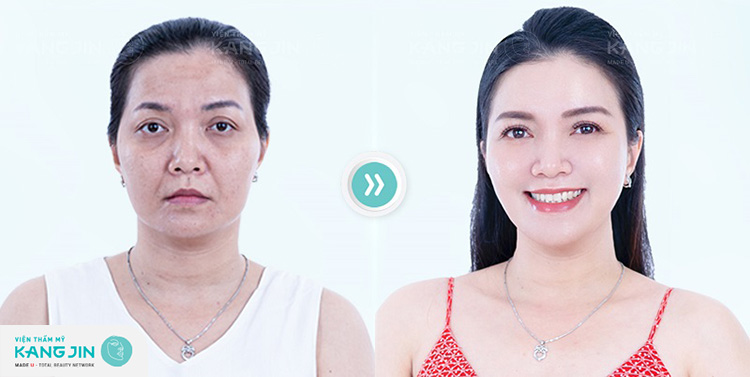 Nếp nhăn trán và rãnh cười sâu đã được loại bỏ sau khi cấy sợi collagen trẻ hóa da mặt bằng công nghệ cao mới nhất