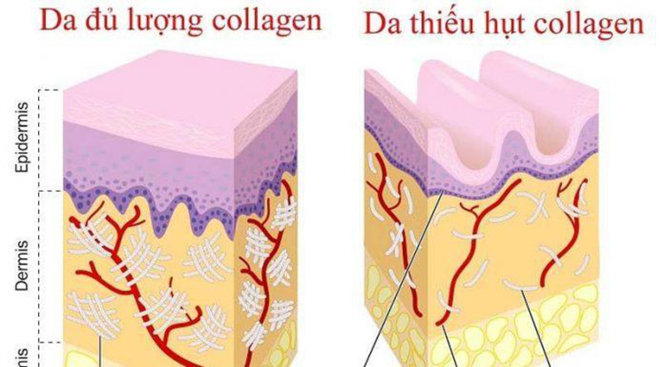 Thiếu hụt collagen gây ra nếp nhăn, da khô sạm